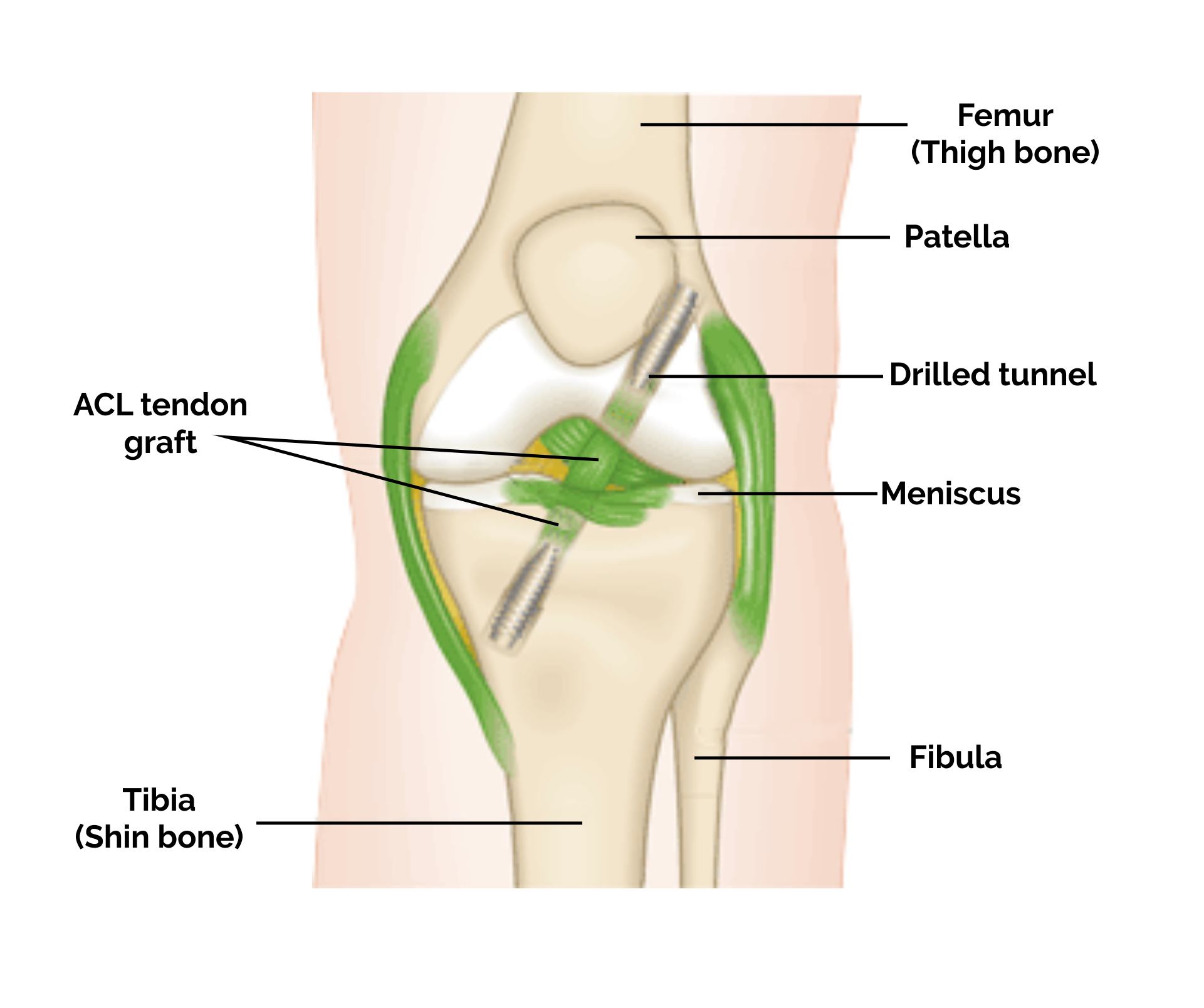 ACL Reconstruction & Repair - Comprehensive Orthopaedic Care
