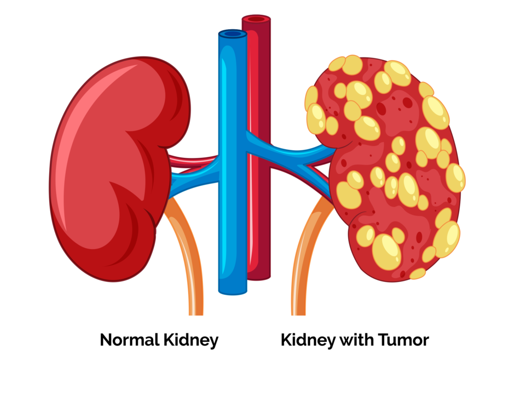 Kidney Cancer-Personalized Oncological Solutions-