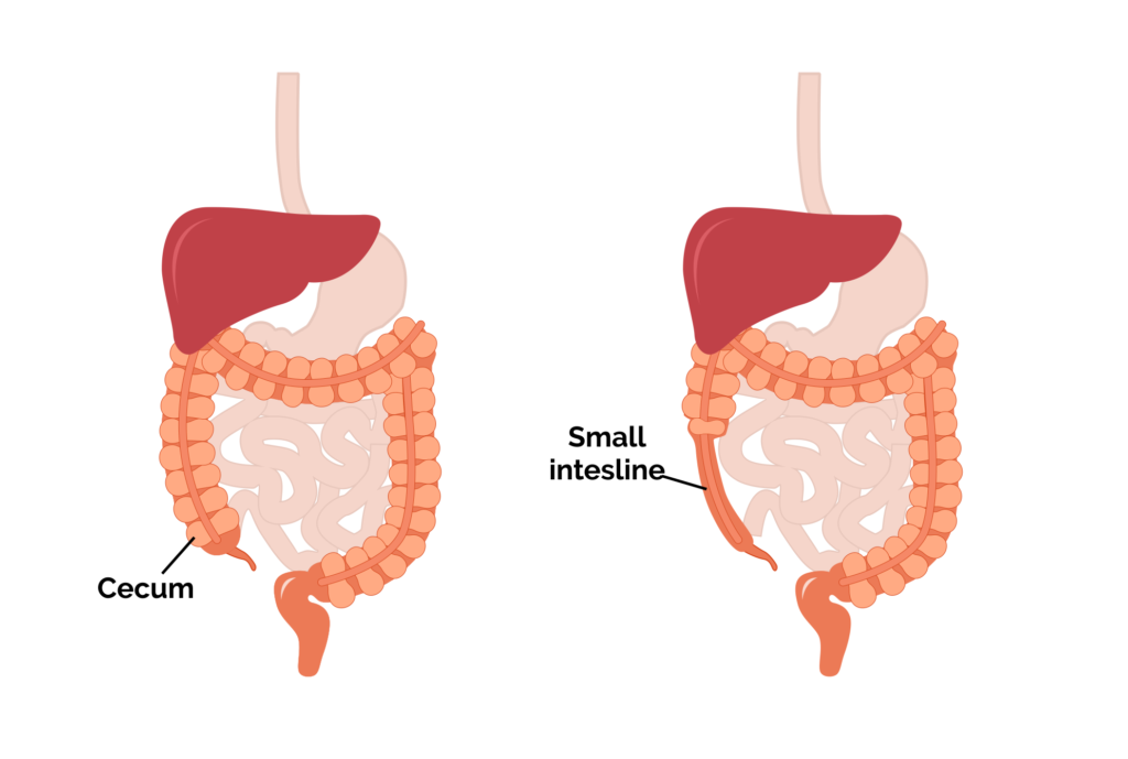 Comprehensive Guide to Laparoscopic HemiColectomy