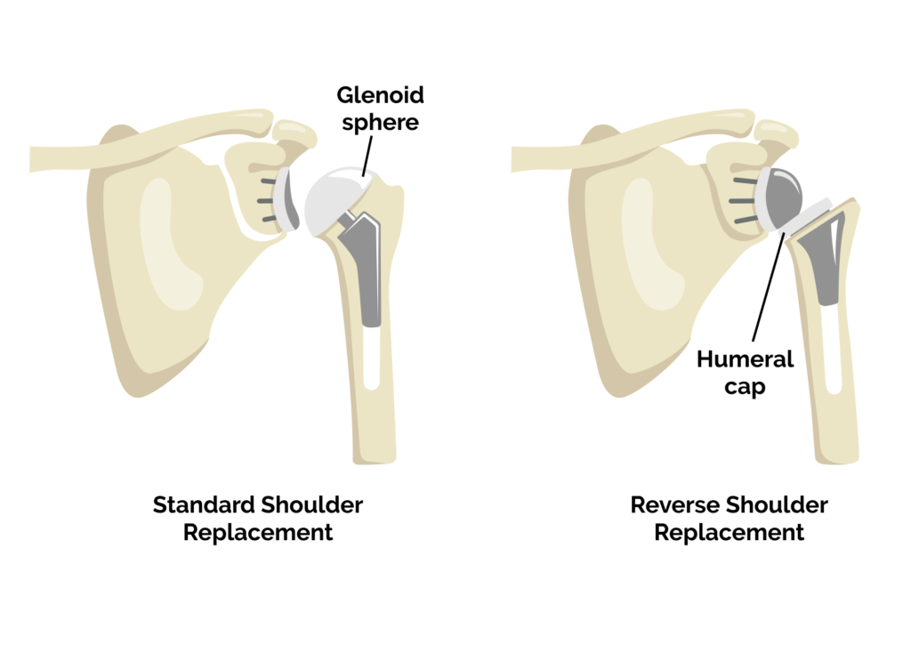 Reverse Shoulder Replacement Treatians Orthopaedics