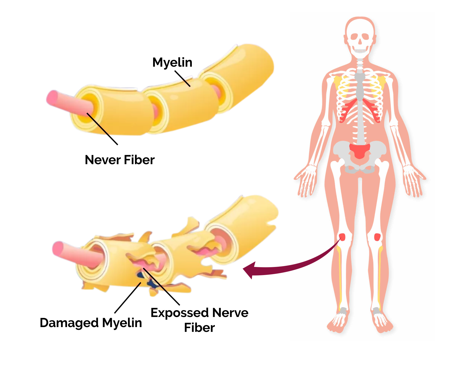 Effective Treatment for GuillainBarre Syndrome