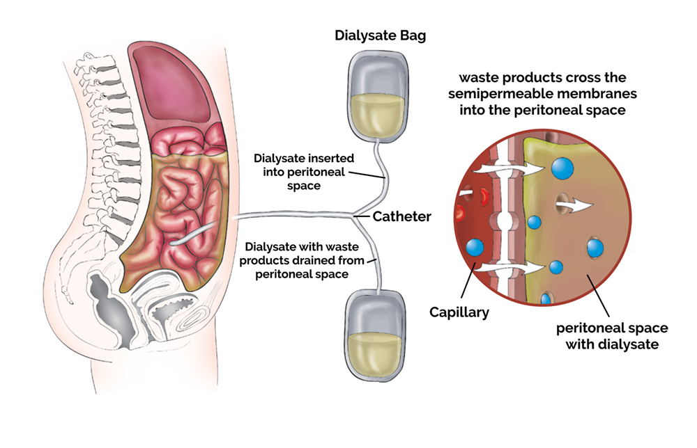 CAPD(Continuous Ambulatory Peritoneal Hemodialysis) and APD Treatians
