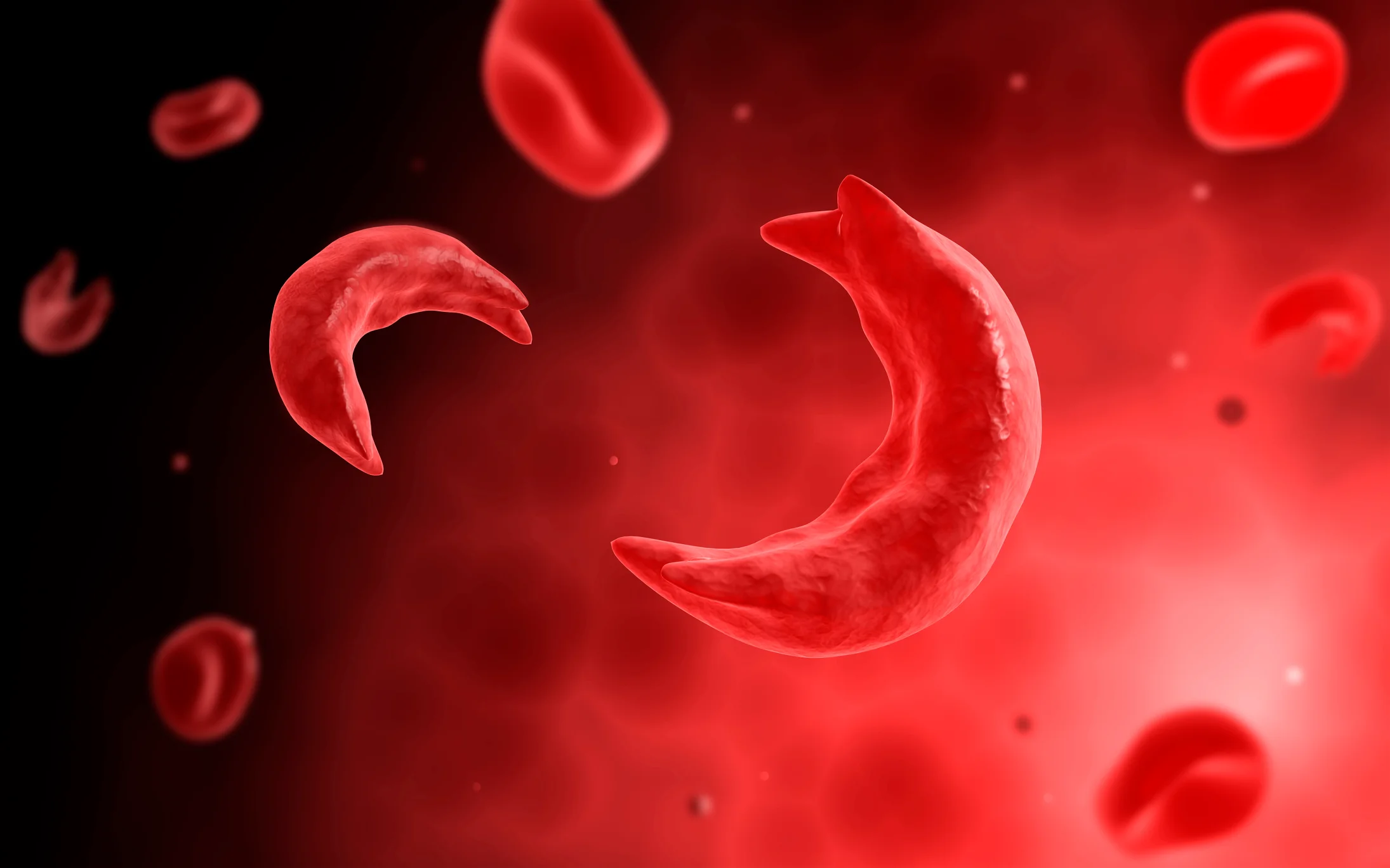 New Gene Therapy For Sickle Cell, Role Of Medical Travel Facilitators!