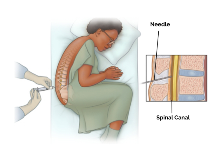 Expert Lumbar Puncture (LP) Procedure at Treatians
