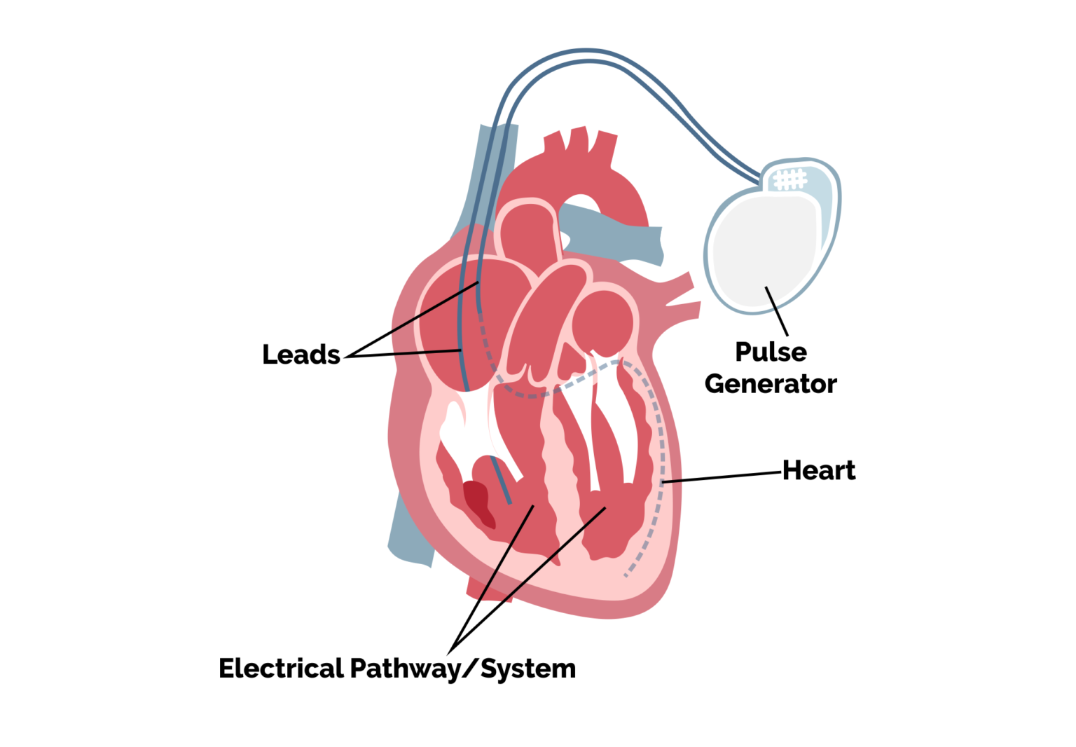 Dual-Chamber Permanent Pacemaker Implantation