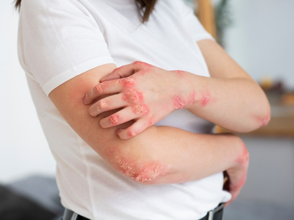 Know About Dermatomyositis: Symptoms, Causes and Treatment