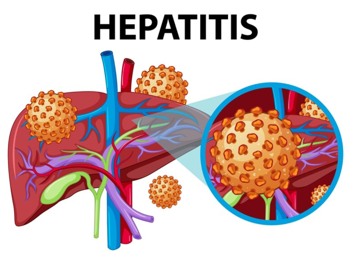 Types of Hepatitis You Must Know!