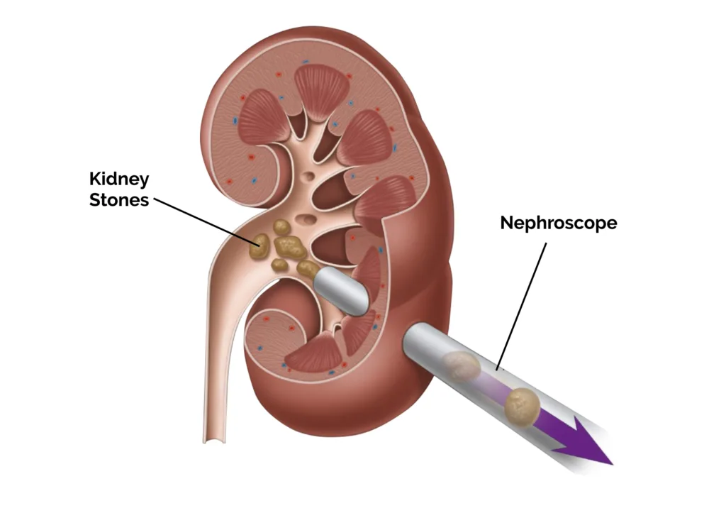 Percutaneous Nephrolithotomy PCNL Unilateral - Diagram
