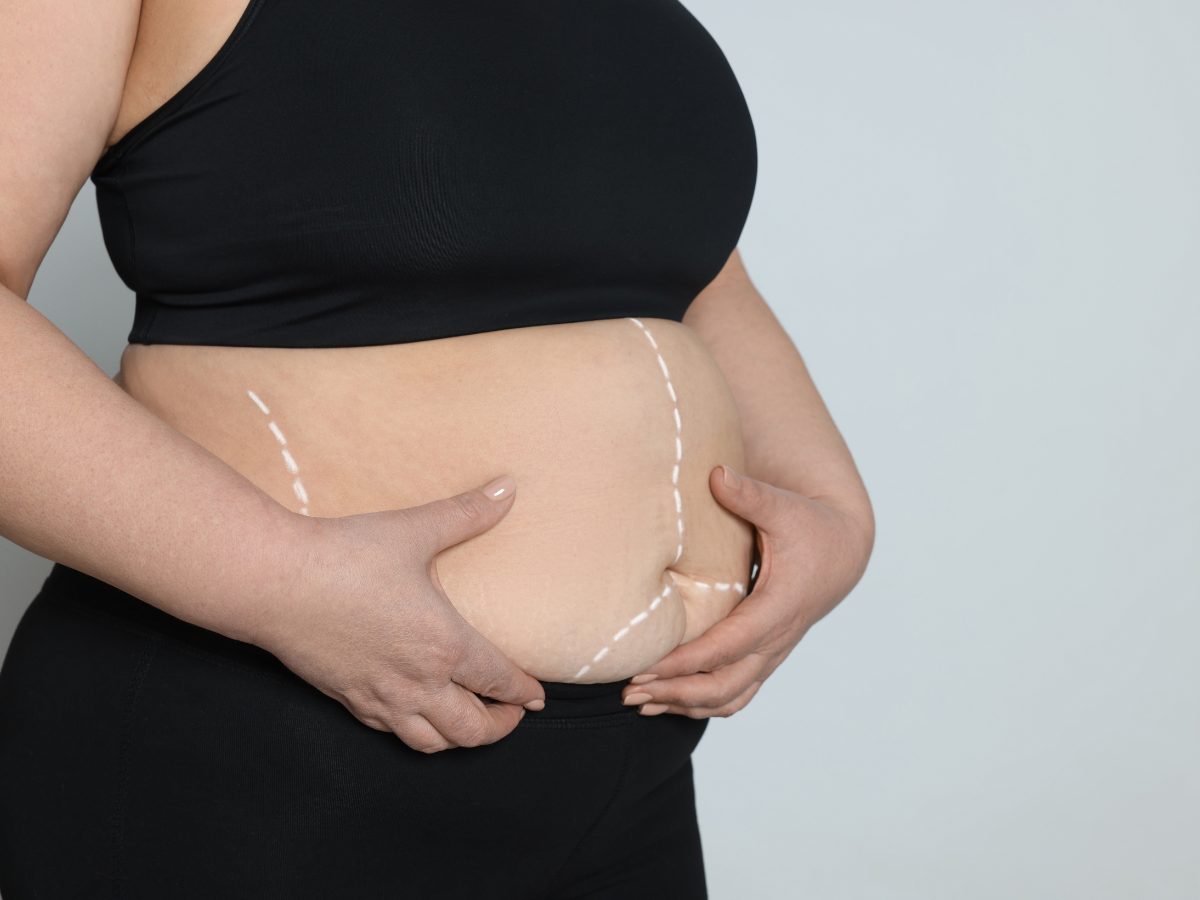 All You Need to Know About Bariatric Surgery for Weight Loss