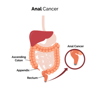 Anal cancer treatment and care by Treatians oncology service