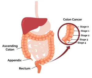 Colon cancer treatment and diagnosis by Treatians oncology service