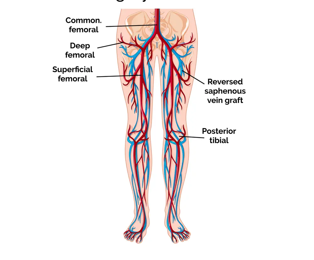 Femoro Popliteal bypass surgery unilateral