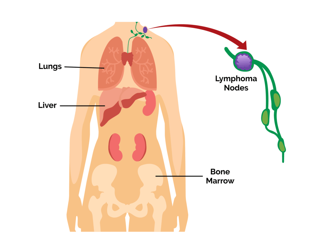 Hodgkin disease treatment and care by Treatians oncology services