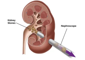 Percutaneous Nephrolithotomy PCNL unilateral kidney stone treatment