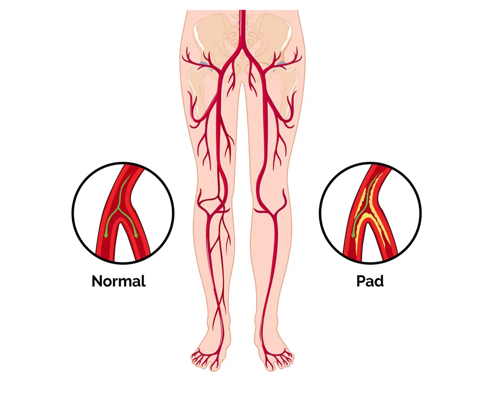 Peripheral Artery Disease treatment