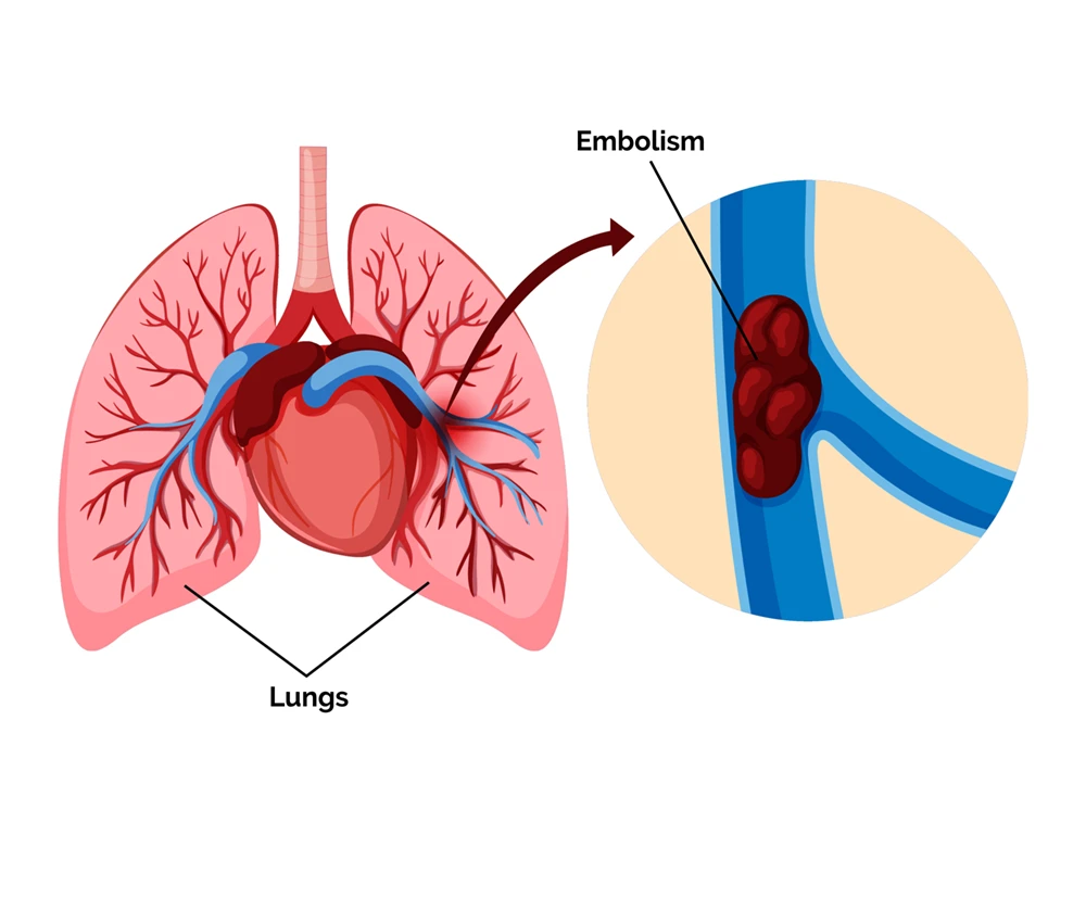 Pulmonary embolism treatment and care