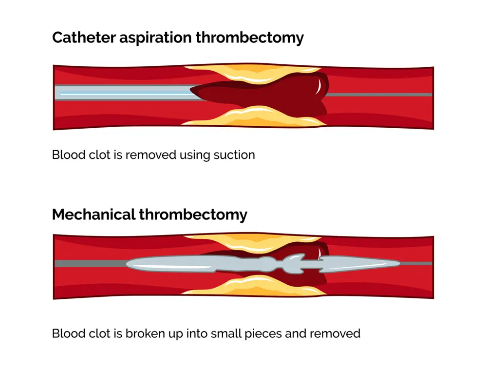 Thrombectomy procedure for blood clot removal