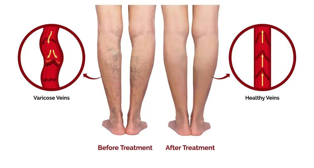Varicose veins treatment and care
