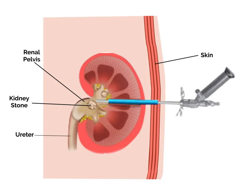 bilateral-pcnl-kidney-stone-treatment