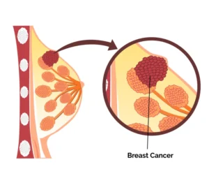 Breast cancer treatment and care by Treatians oncology service