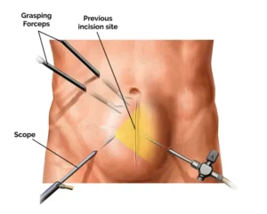 laparoscopic-mesh-hernia-repair