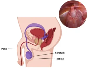 open laparoscopic nephrectomy surgery