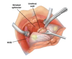 open radical prostatectomy surgery