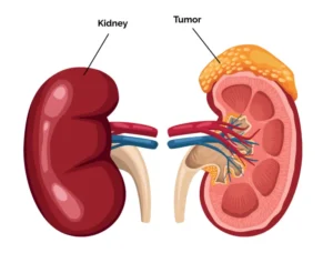 partial-nephrectomy-surgery-kidney