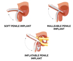 Penile Implant Surgery for Erectile Dysfunction