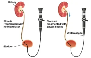 RIRS unilateral kidney stone surgery