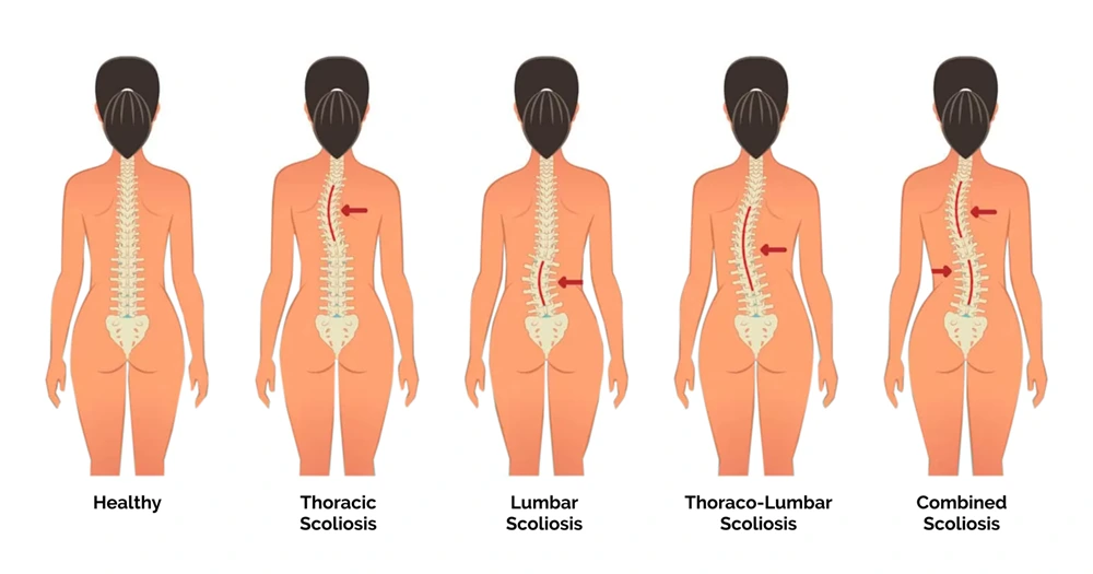 scoliosis spine correction treatment benefits
