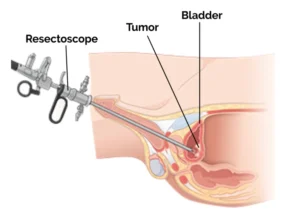 TURBT bladder tumor surgery