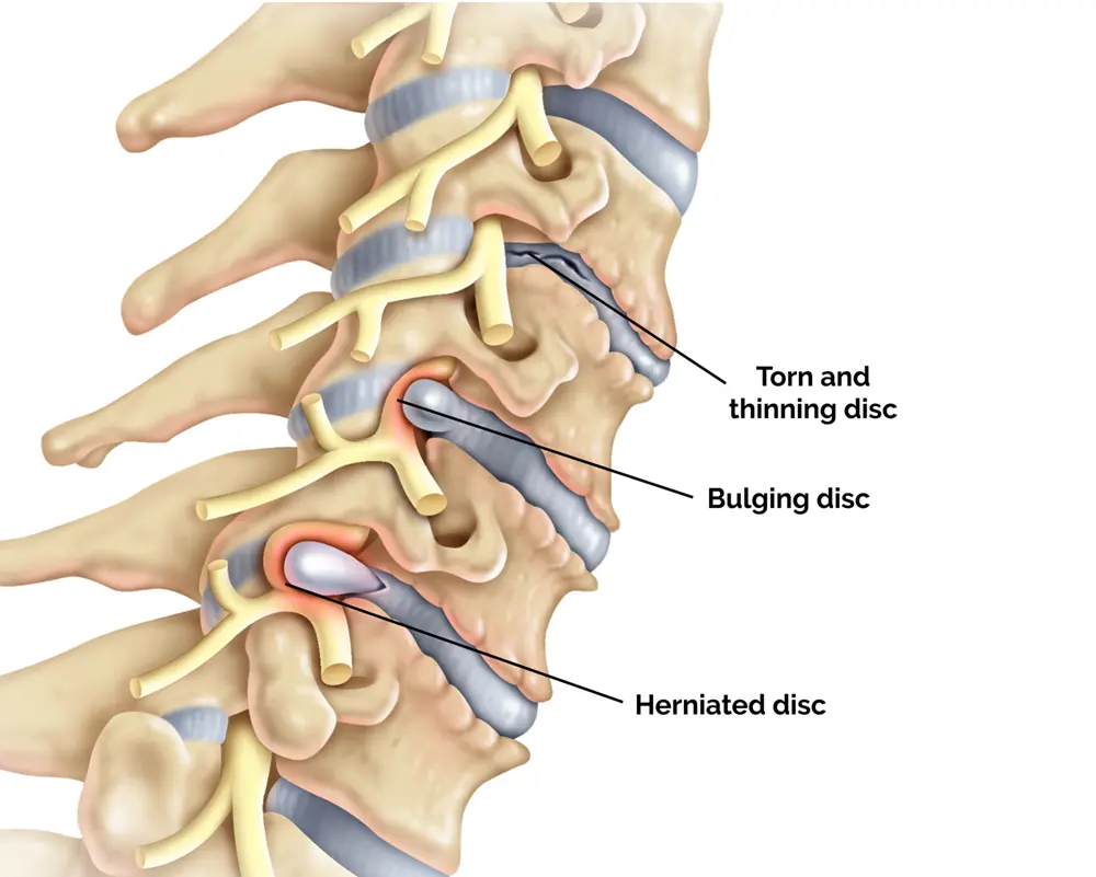 Cervical spine stabilization with disc replacement surgery
