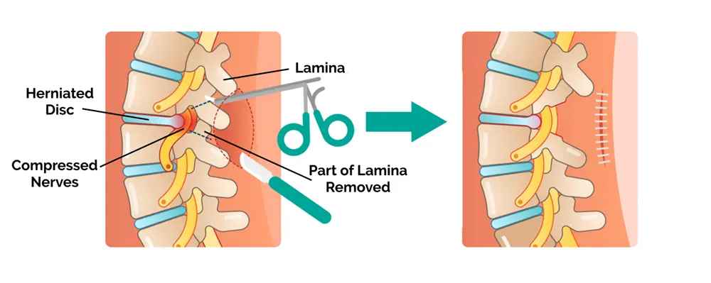 Cervical spine laminectomy and discectomy with fixation surgery