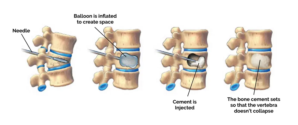Minimally invasive kyphoplasty surgery for spine fractures