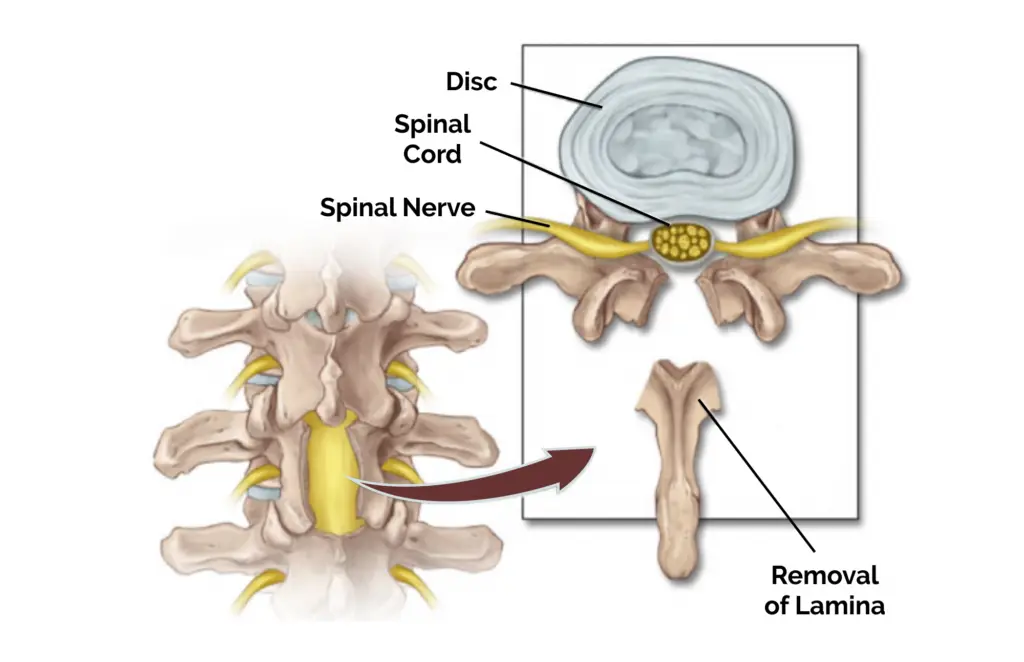Laminectomy and lumbar spine fixation surgery