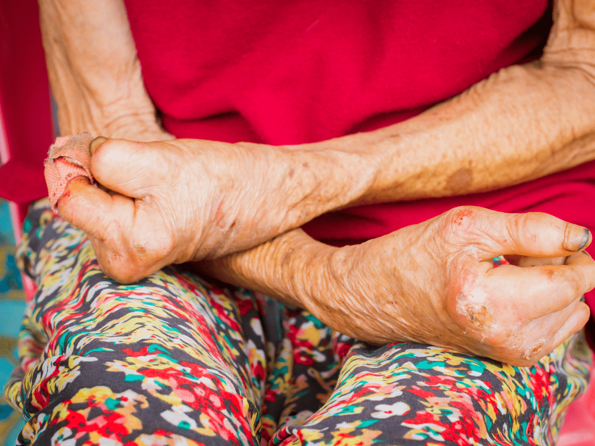 Spreading Awareness Of Disease, This World Leprosy Day