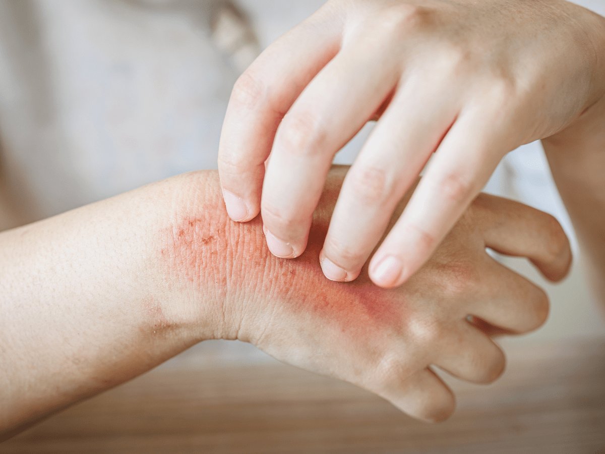 Fungal Infection: Causes, Symptoms & Prevention